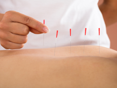 Dry Needling